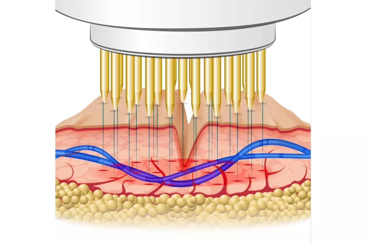 What is Fractional Radio Frequency?