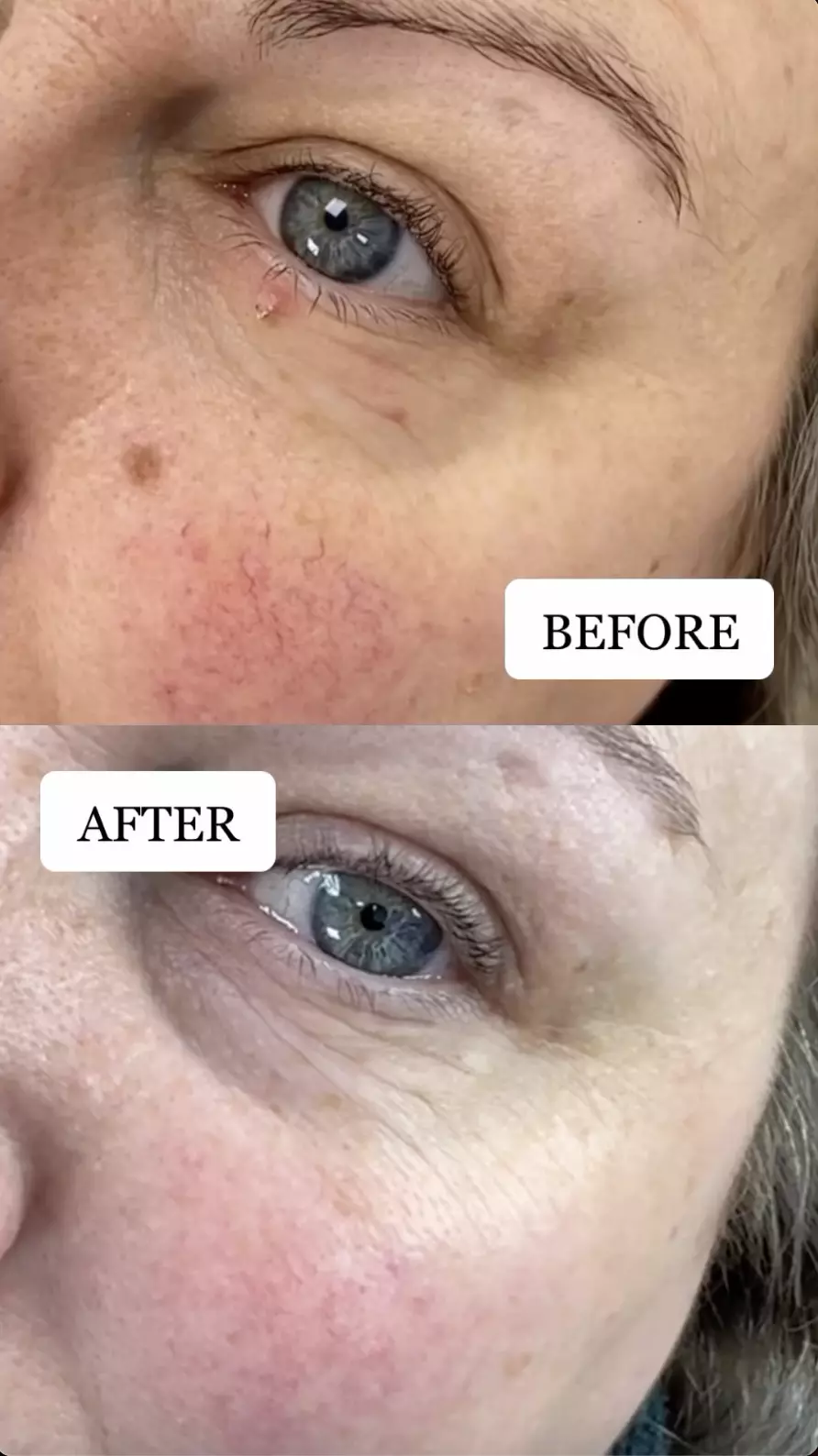 BeautyEditorUK on instagram electrocautery results