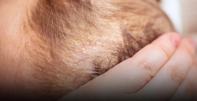 CRADLE CAP: WHAT IT IS, AND WHAT TO DO ABOUT IT